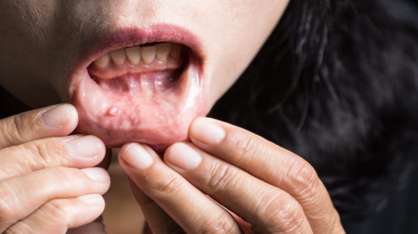 Câncer de boca: saiba como detectar a doença precocemente
