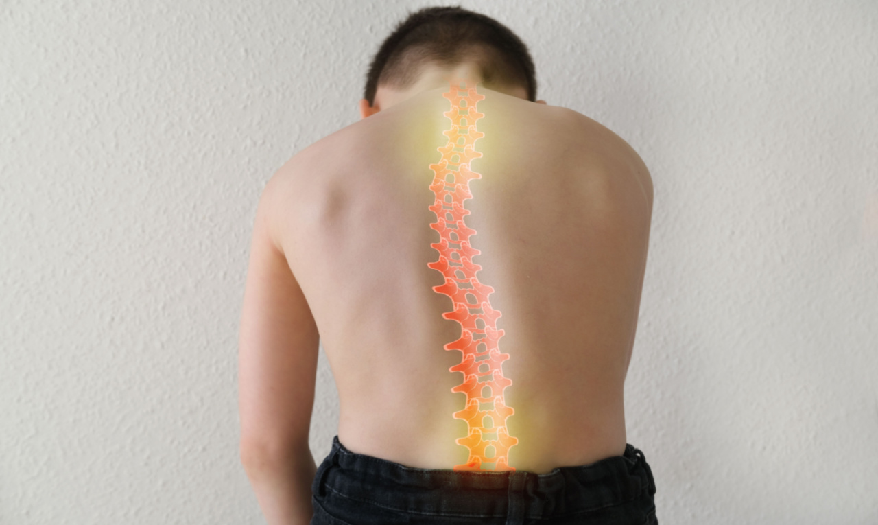 Escoliose infantil: quando a cirurgia é uma opção? Entenda