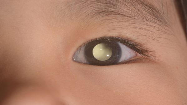 Retinoblastoma: doença não tem prevenção, mas tem cura; entenda