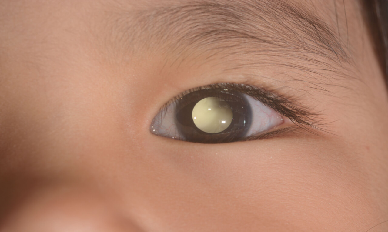 Retinoblastoma: doença não tem prevenção, mas tem cura; entenda