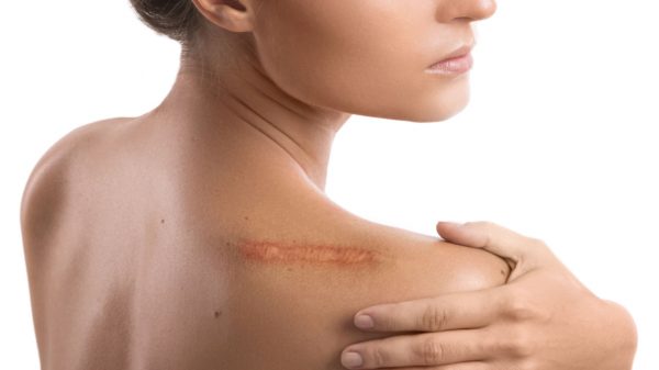 Como melhorar a aparência das cicatrizes? Médico ensina