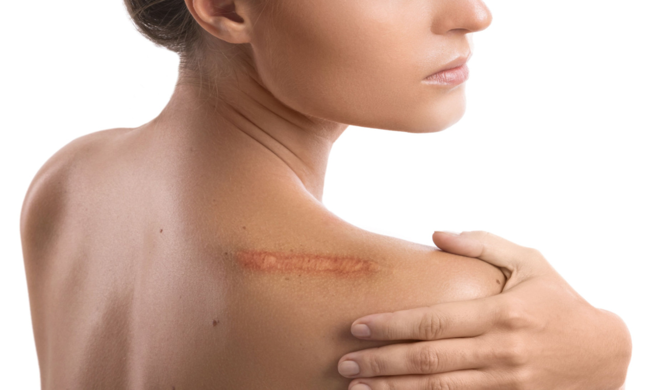 Como melhorar a aparência das cicatrizes? Médico ensina