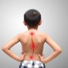 Escoliose em crianças e adolescentes: como identificar os primeiros sinais