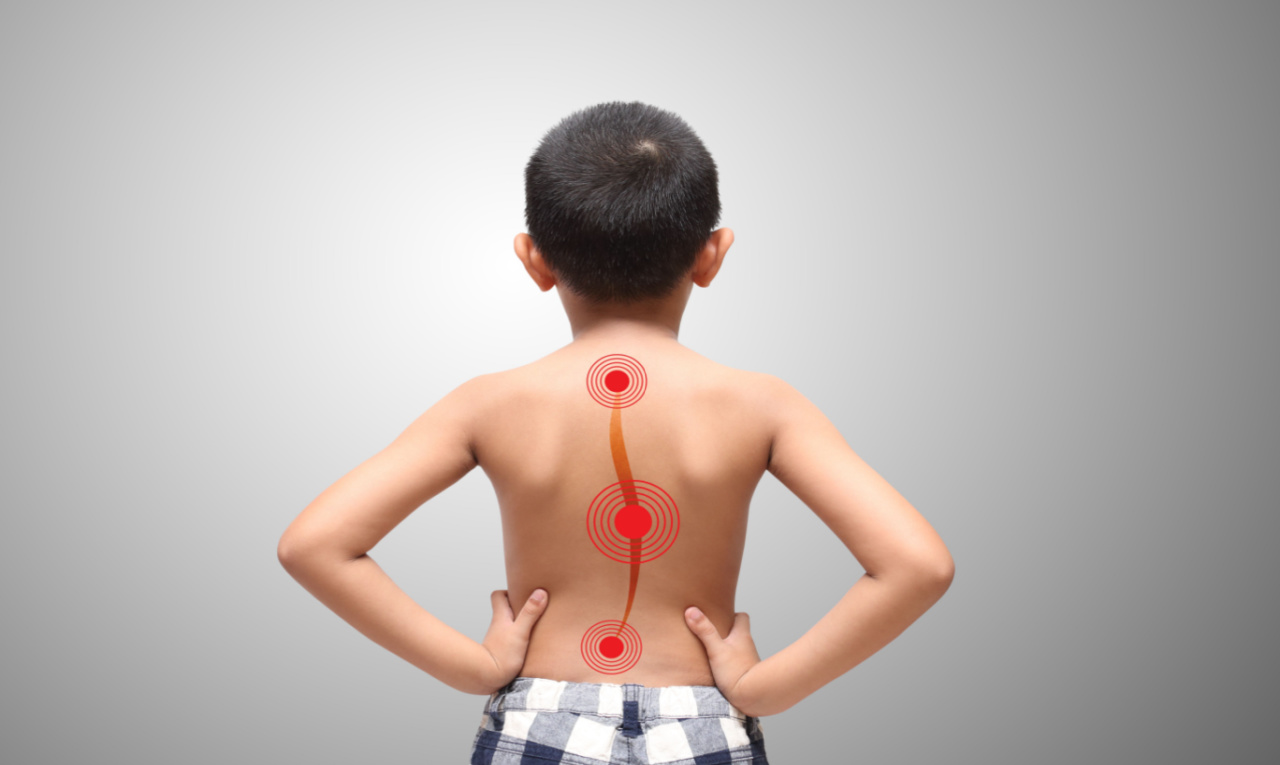 Escoliose em crianças e adolescentes: como identificar os primeiros sinais