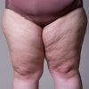 Lipedema: entenda como é a cirurgia para tratar a condição