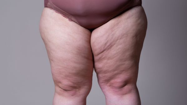 Lipedema: entenda como é a cirurgia para tratar a condição