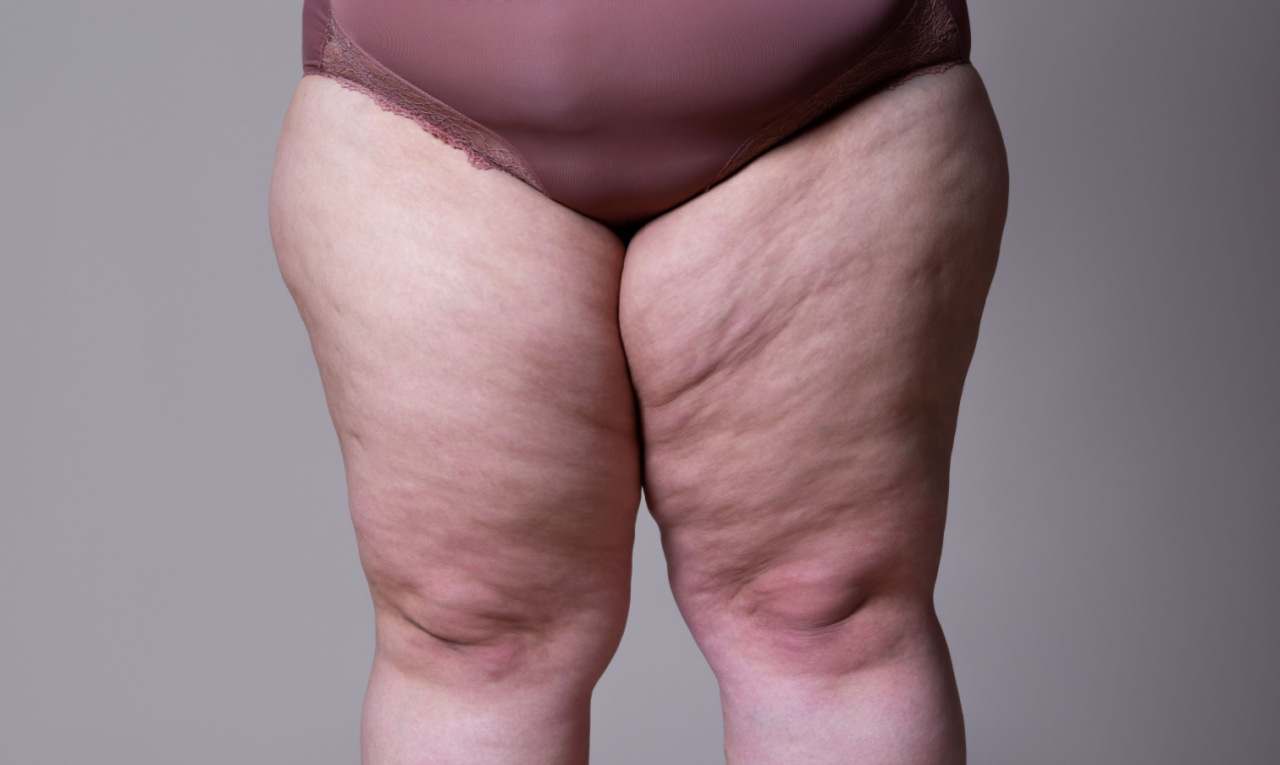 Lipedema: entenda como é a cirurgia para tratar a condição