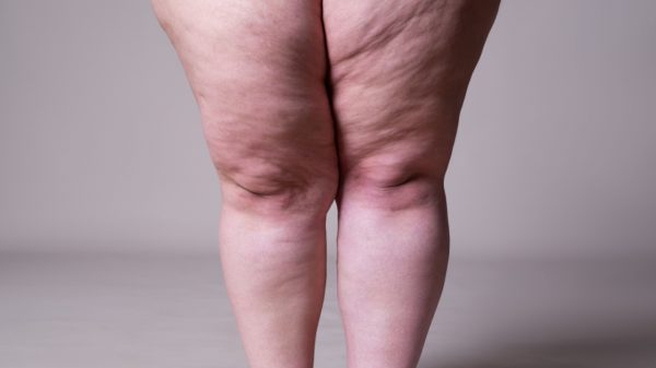 Tudo sobre lipedema - Saúde em Dia