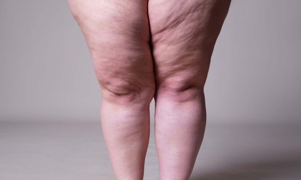 Lipedema: alimentação pode agravar e também tratar a doença