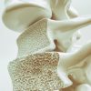 Osteoporose: 4 fatos para entender a doença