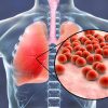 Pneumonia: conheça as opções de vacinas contra a doença