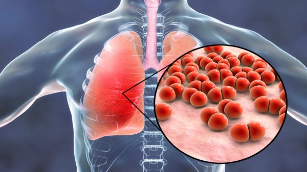 Pneumonia: conheça as opções de vacinas contra a doença