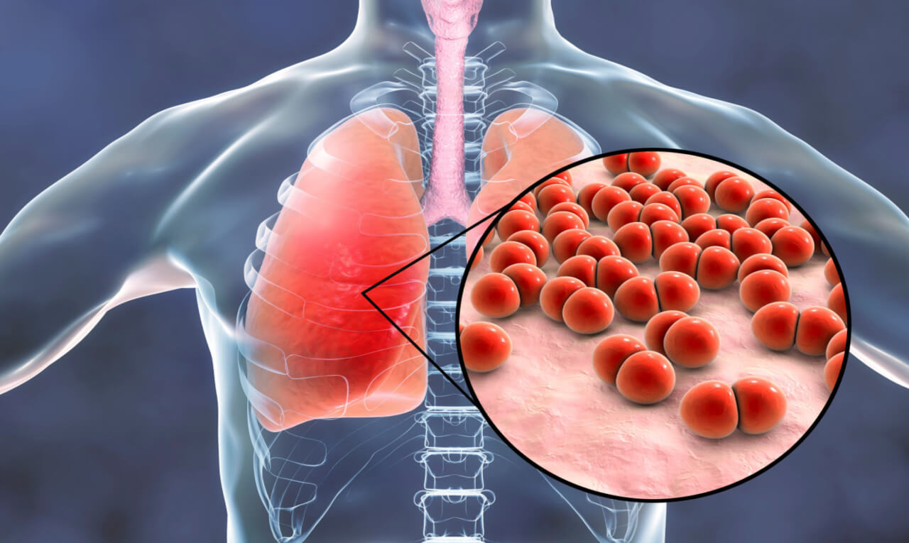 Pneumonia: conheça as opções de vacinas contra a doença