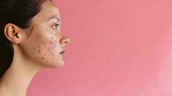 O verão está chegando! Saiba como cuidar da acne na estação