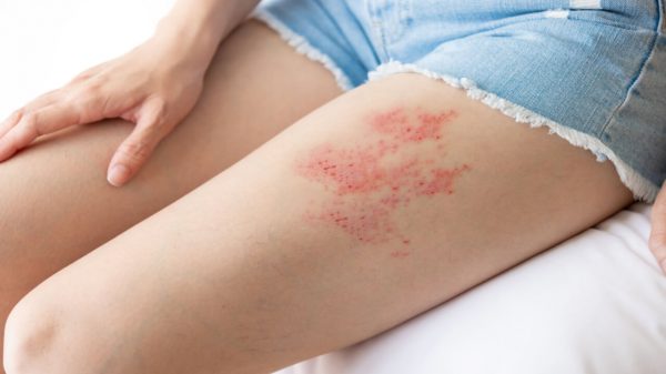 Dor pós herpes-zóster: médica revela como tratar o problema