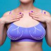 Melhora a silhueta e a postura: conheça os benefícios da mamoplastia redutora
