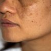 Melasma e sol: saiba como amenizar as manchas no verão