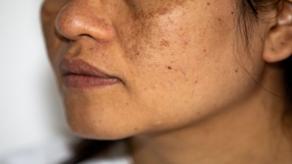 Melasma e sol: saiba como amenizar as manchas no verão