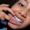 Filha de Kanye West exibe prótese de titânio: quais os riscos dos grillz?