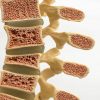 Osteoporose pode atingir a coluna: conheça os sinais e como tratar