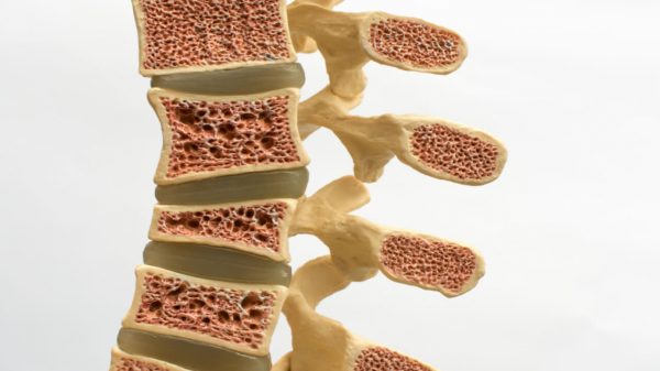 Osteoporose pode atingir a coluna: conheça os sinais e como tratar
