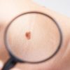 Regra do ABCDE: aprenda a fazer o autoexame para câncer de pele
