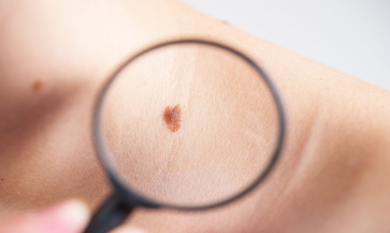 Regra do ABCDE: aprenda a fazer o autoexame para câncer de pele