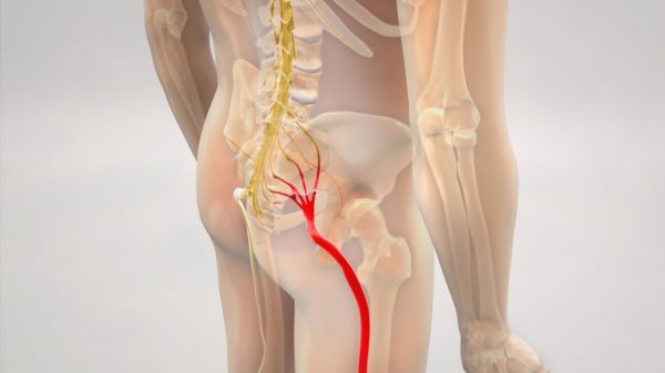 Dor no ciático: entenda o que causa e como tratar o problema