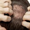Calvície precoce: vejas as causas de perda de cabelo entre os jovens