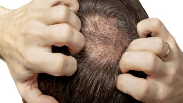 Calvície precoce: vejas as causas de perda de cabelo entre os jovens