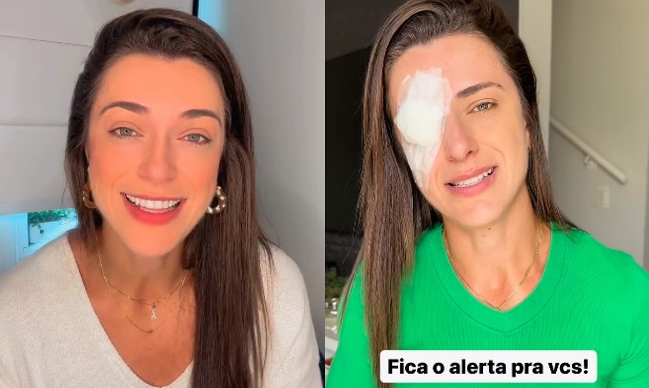 Influencer tem inflamação na córnea após usar cera para cabelo; entenda