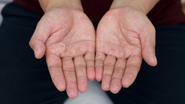 Bolhas nas mãos e coceira? Saiba se é disidrose