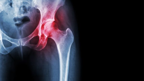 Dor e rigidez: conheça os sinais de artrose de quadril