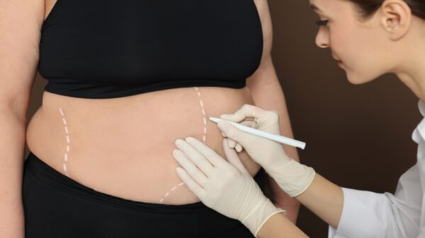 Médico revela 10 verdades sobre a cirurgia bariátrica