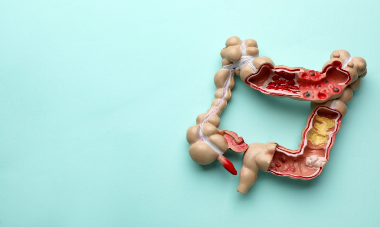 Maio Roxo: entenda as Doenças Inflamatórias Intestinais