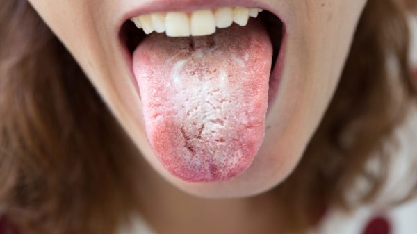 Saburra lingual: veja o que deixa a língua branca