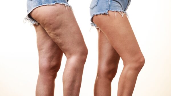 Sofre de lipedema e varizes? Saiba por onde começar o tratamento