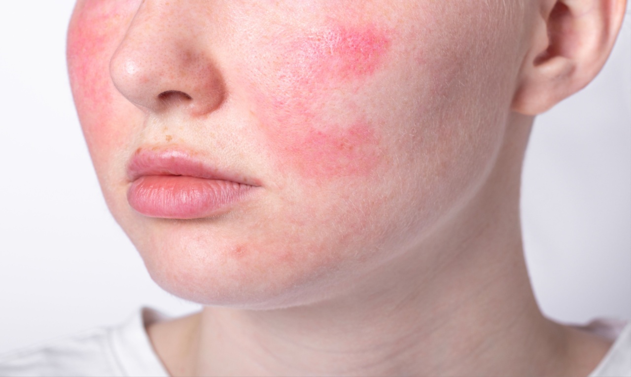 Estado emocional pode causar manchas vermelhas na pele; entenda