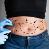 Cirurgião plástico responde 5 dúvidas sobre a abdominoplastia