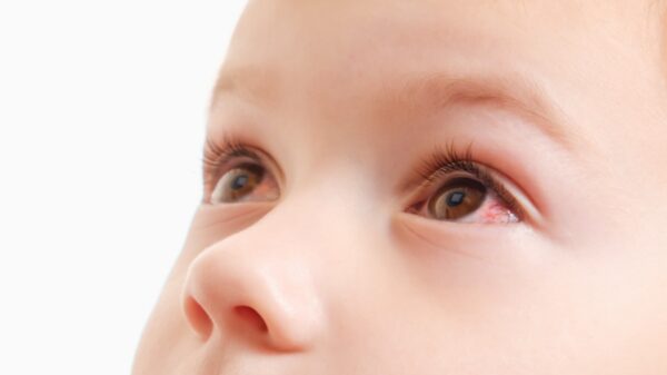 Crianças também têm glaucoma! Entenda a condição