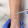 Entenda como identificar e tratar cada tipo de alergia