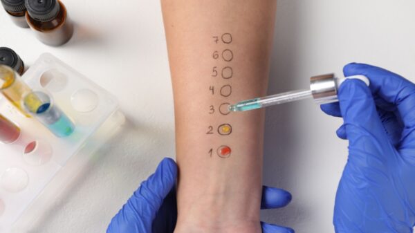 Entenda como identificar e tratar cada tipo de alergia