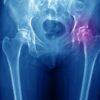 Será que é artrose? Conheça os sintomas que atingem o quadril