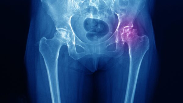 Será que é artrose? Conheça os sintomas que atingem o quadril
