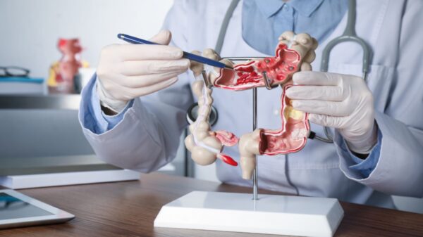 Médico alerta sobre os principais tipos de câncer do aparelho digestivo