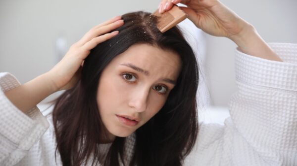 Caspa? Veja como tratar a dermatite seborreica