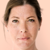Terapias orais e combinadas, novos cosmecêuticos e até inteligência artificial prometem diminuir o melasma