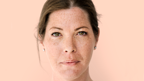 Terapias orais e combinadas, novos cosmecêuticos e até inteligência artificial prometem diminuir o melasma