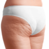 A lipoaspiração melhora a estética e diminui as dores causadas pelo lipedema