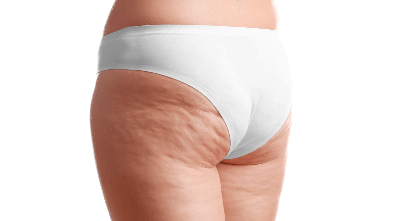 A lipoaspiração melhora a estética e diminui as dores causadas pelo lipedema